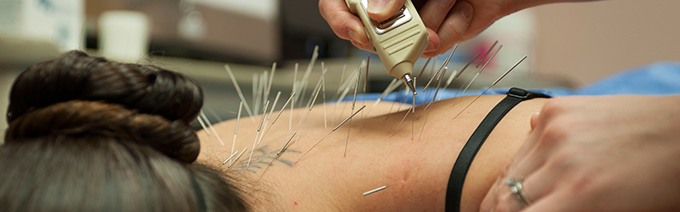 Acupuncture needles in place